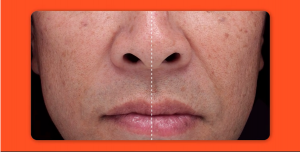 ポーラ リンクル ショット メディカル セラム